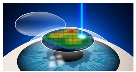 Custom Wavefront LASIK Technology