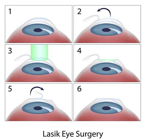 LASIK Eye Surgery Process